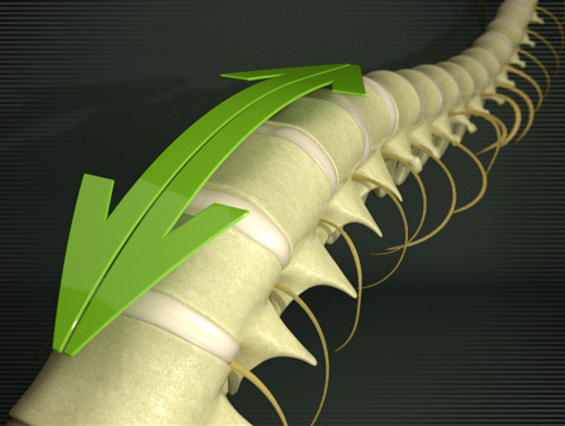 Spinal Decom
